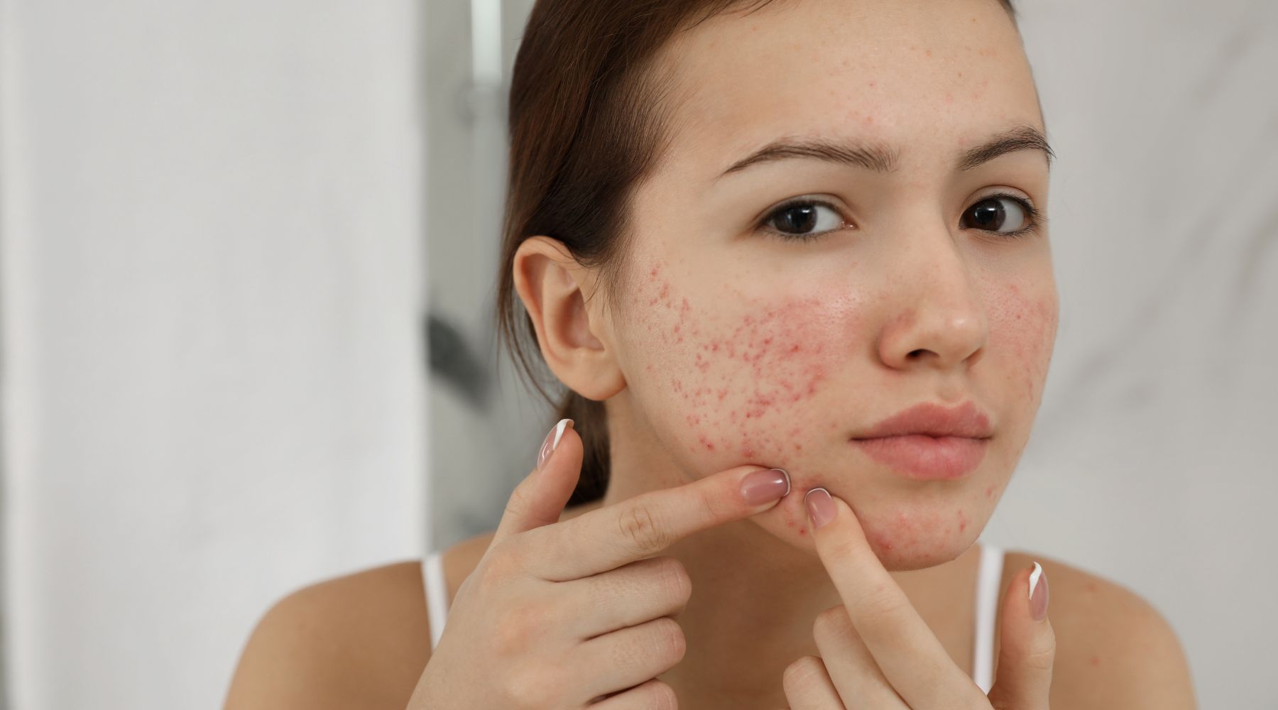 Acne Awareness Month - SkinShop