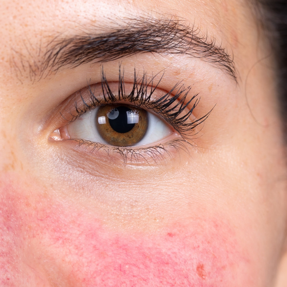 Redness & Rosacea